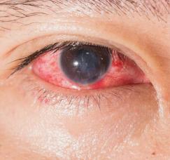 眼睛红血丝有可能是结膜炎